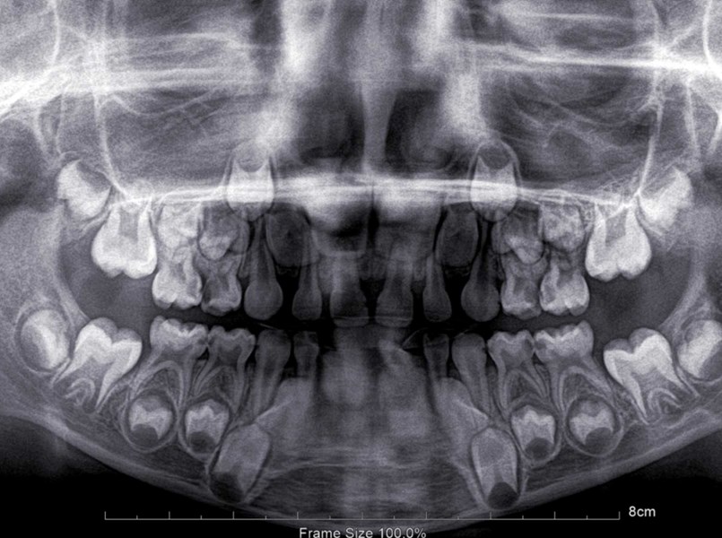 quando cadono i denti da latte